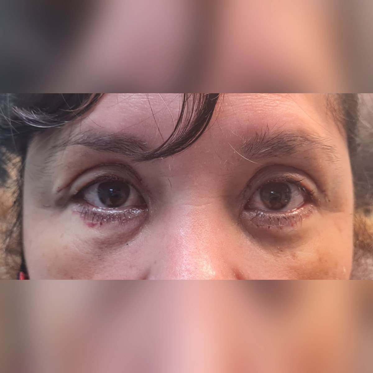 Corrección de ptosis — después
