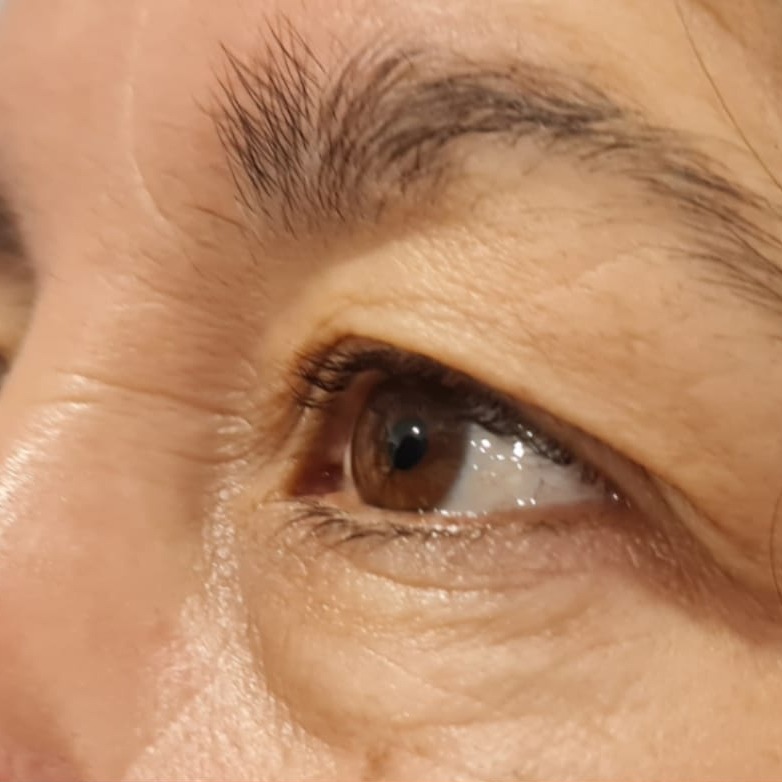 Blefaroplastia — antes