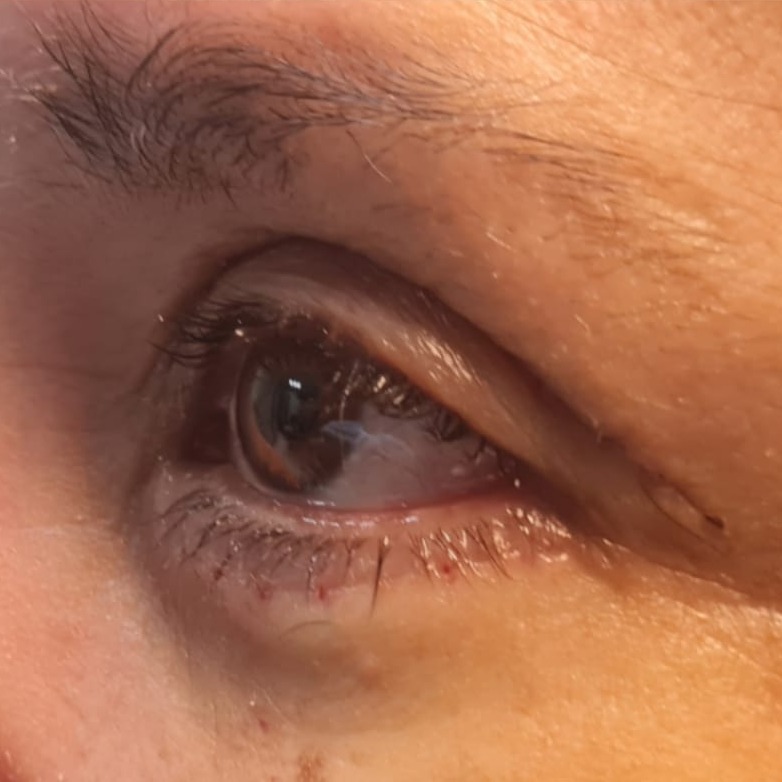 Blefaroplastia — después