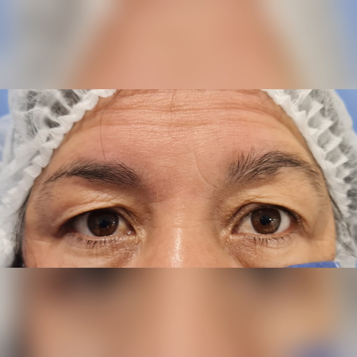 Corrección de ptosis — antes